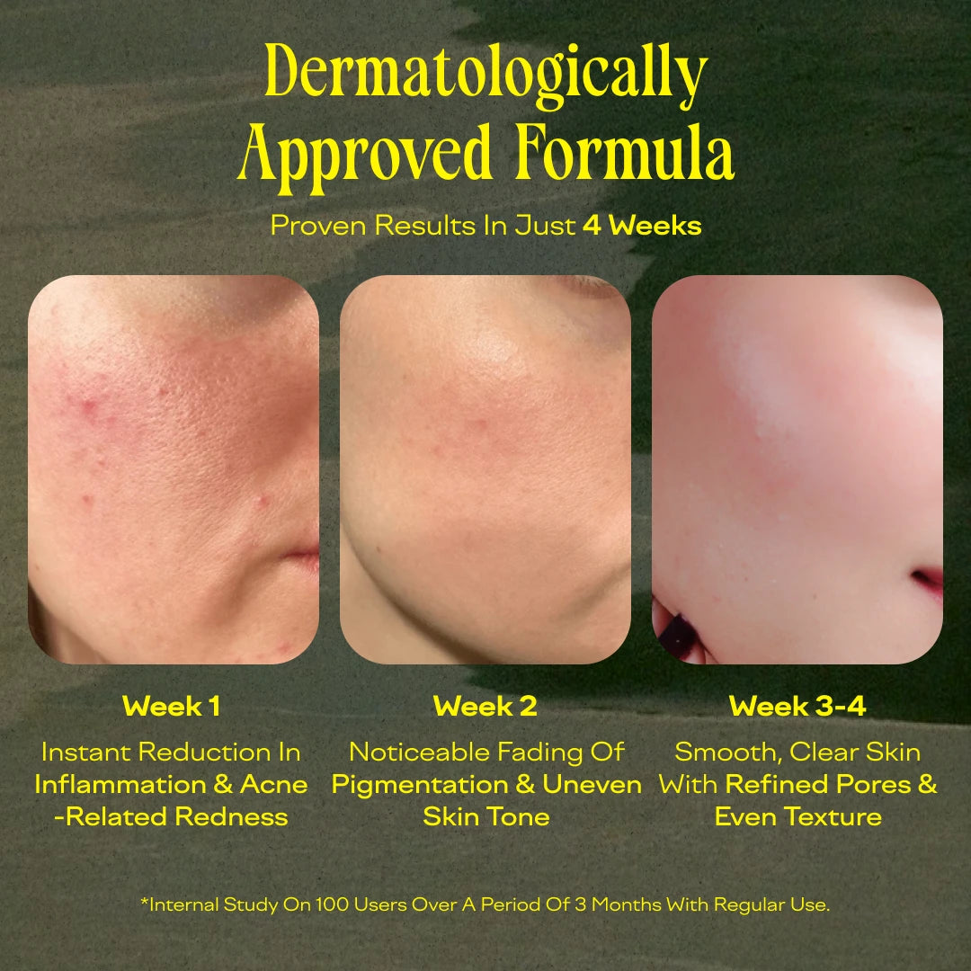 India's Only 14% Pure Azelaic Acid Serum for Acne & Pigmentation