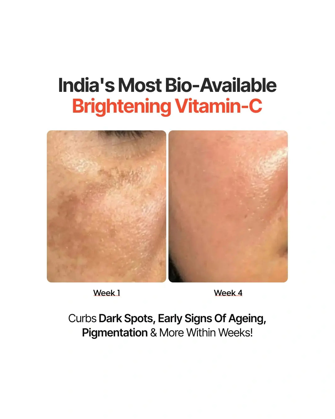 4-Week Hyperpigmentation Treatment