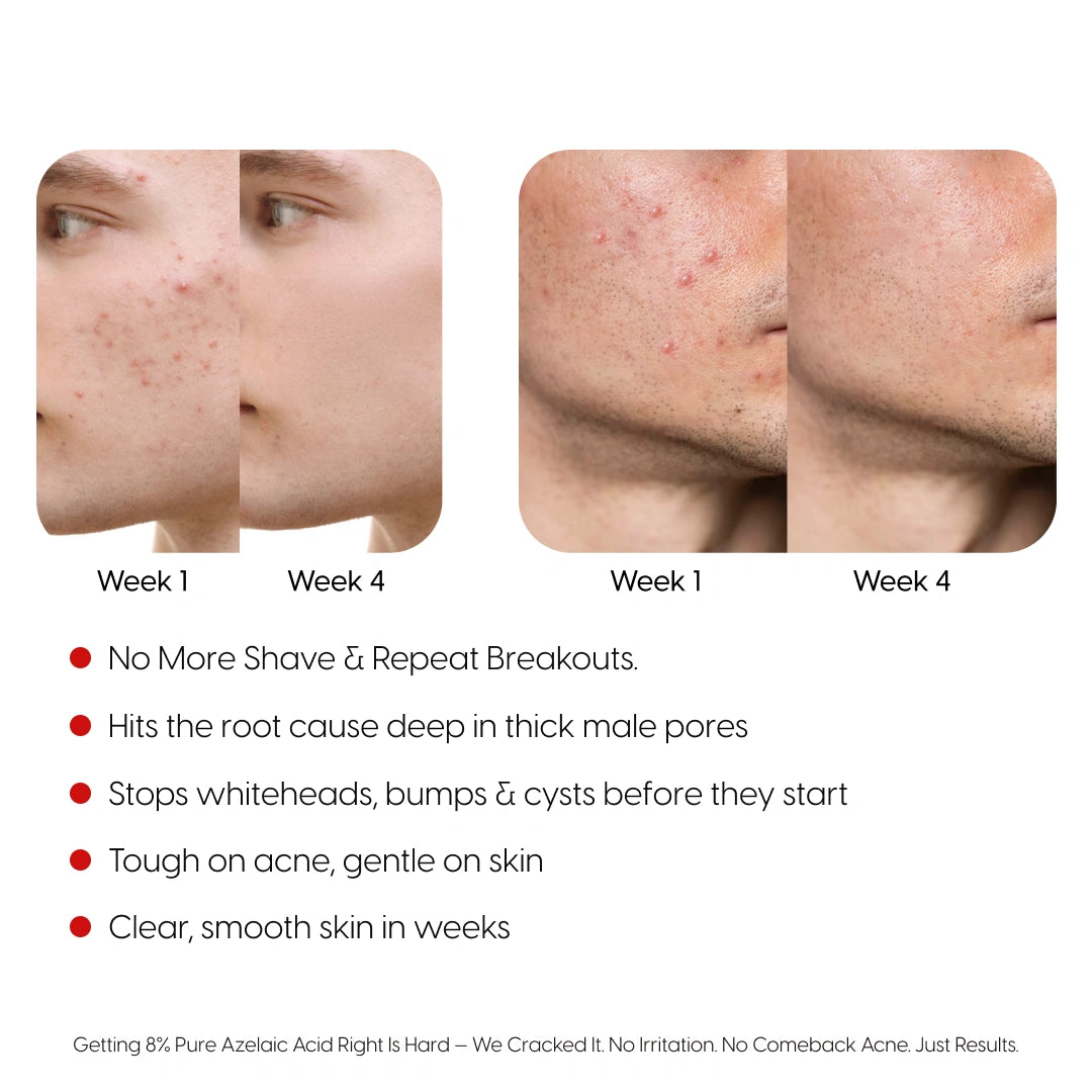 8% Pure Azelaic Acid Serum Ends Post-Shave Acne For Good