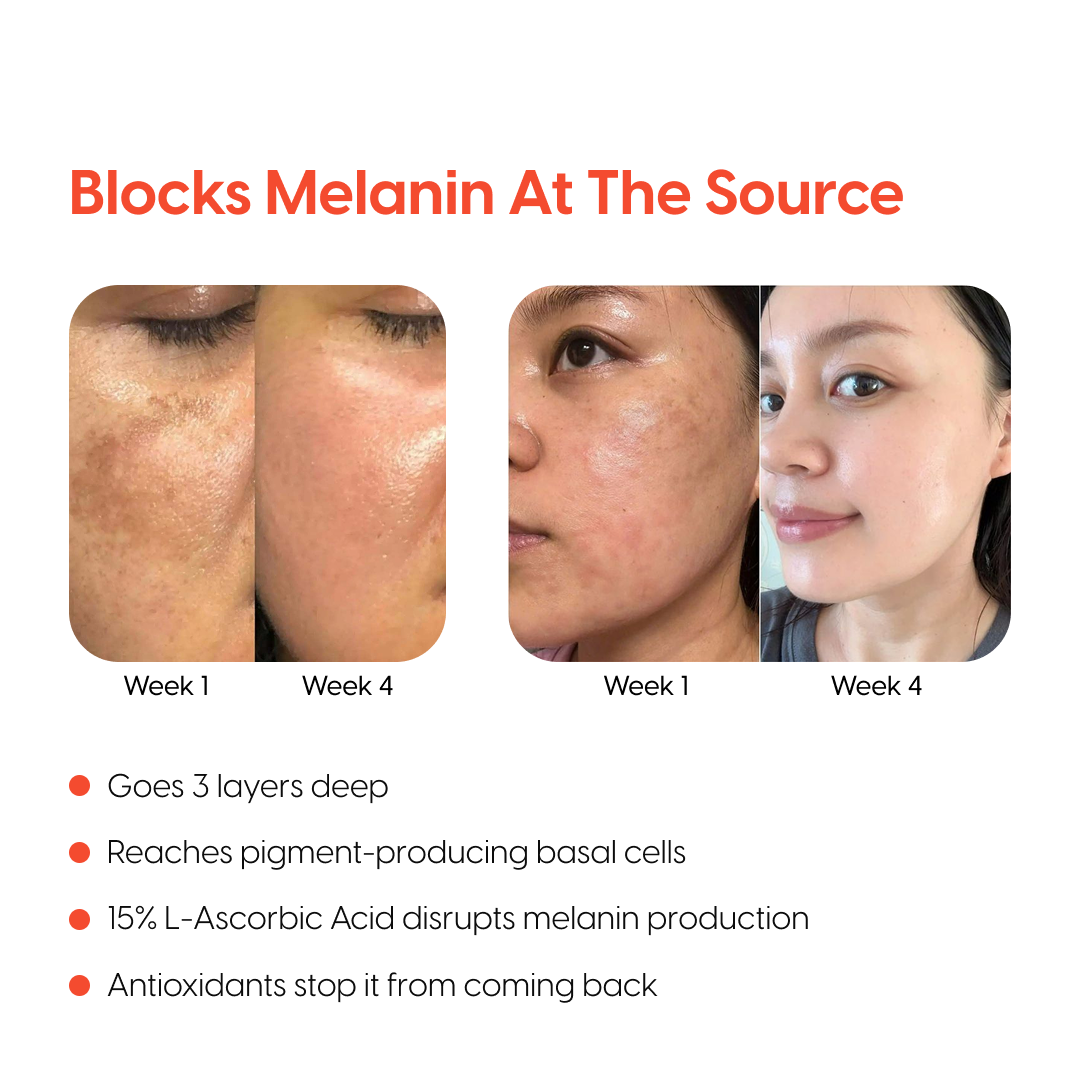 4-Week Hyperpigmentation Treatment