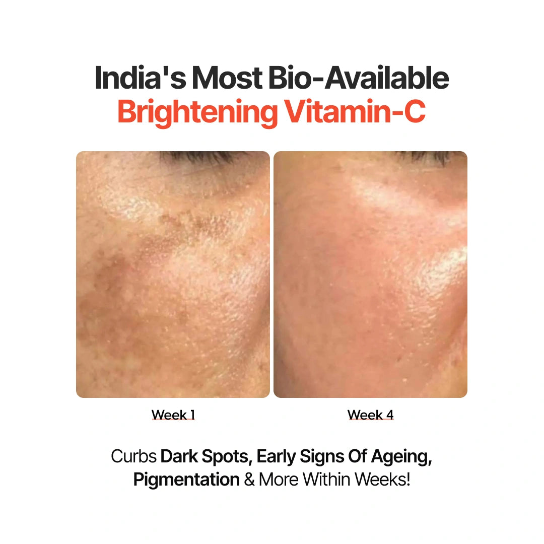 4-Week Hyperpigmentation Treatment