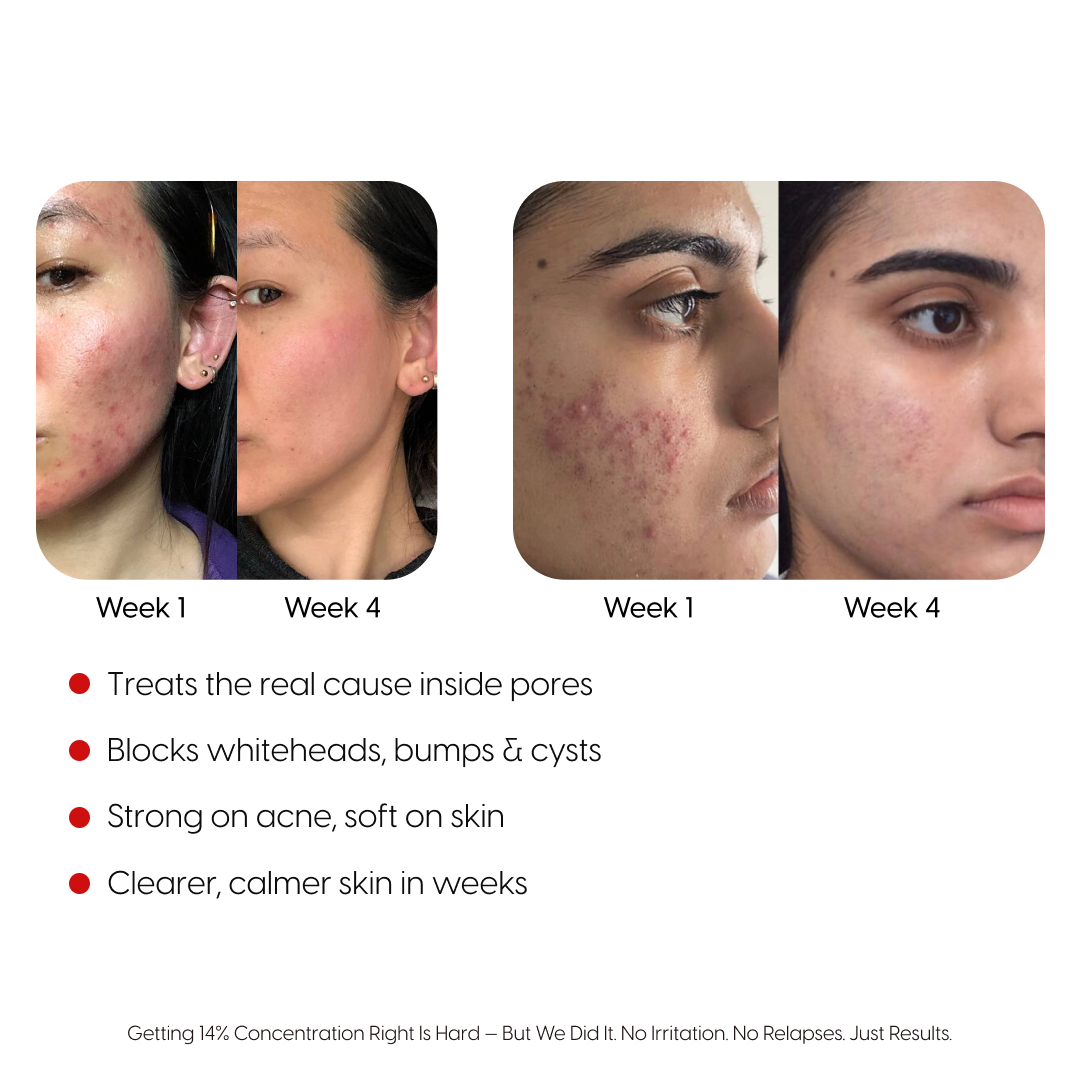 14% Pure Azelaic Acid Serum The Only Ingredient That Truly Ends Acne