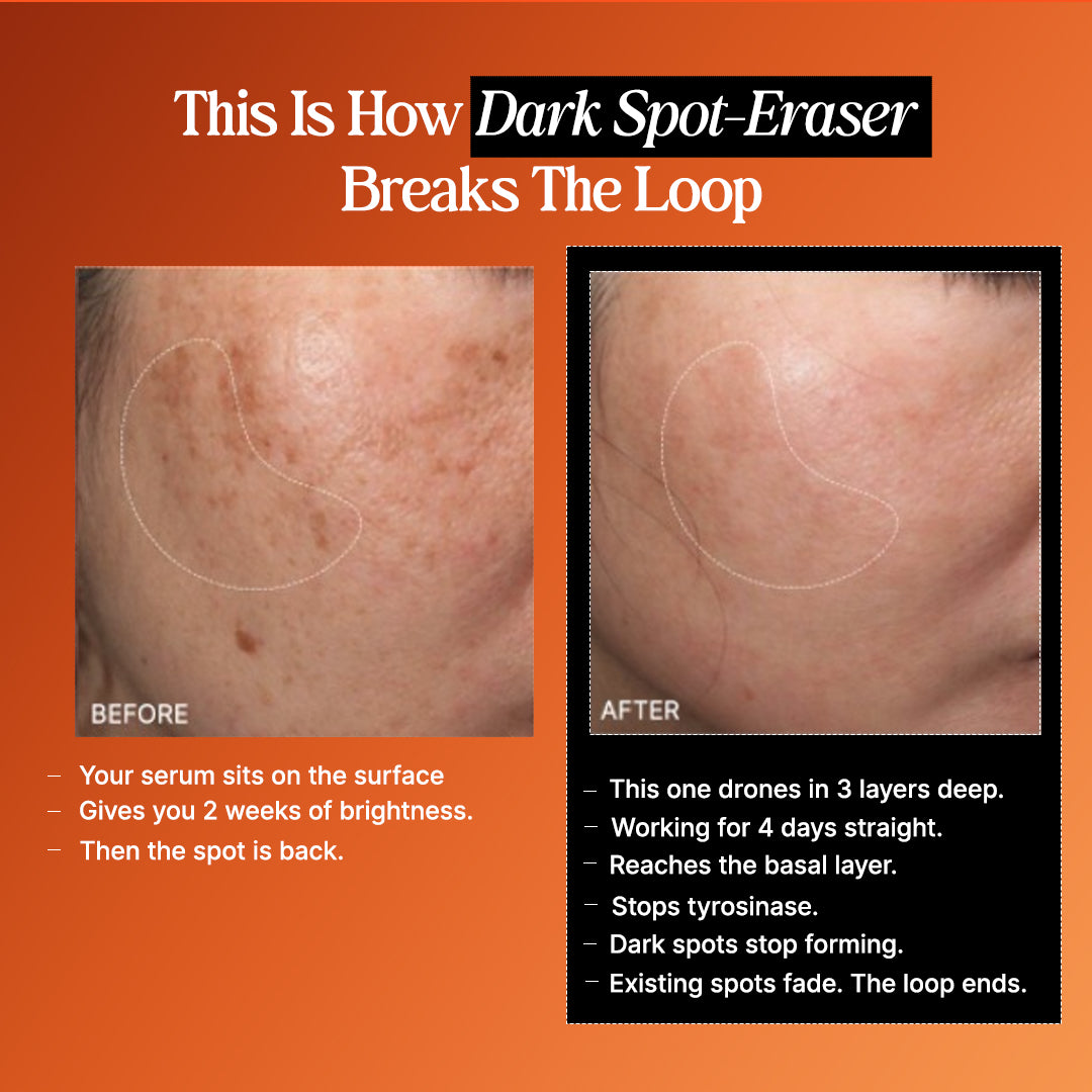 4-Week Hyperpigmentation Treatment