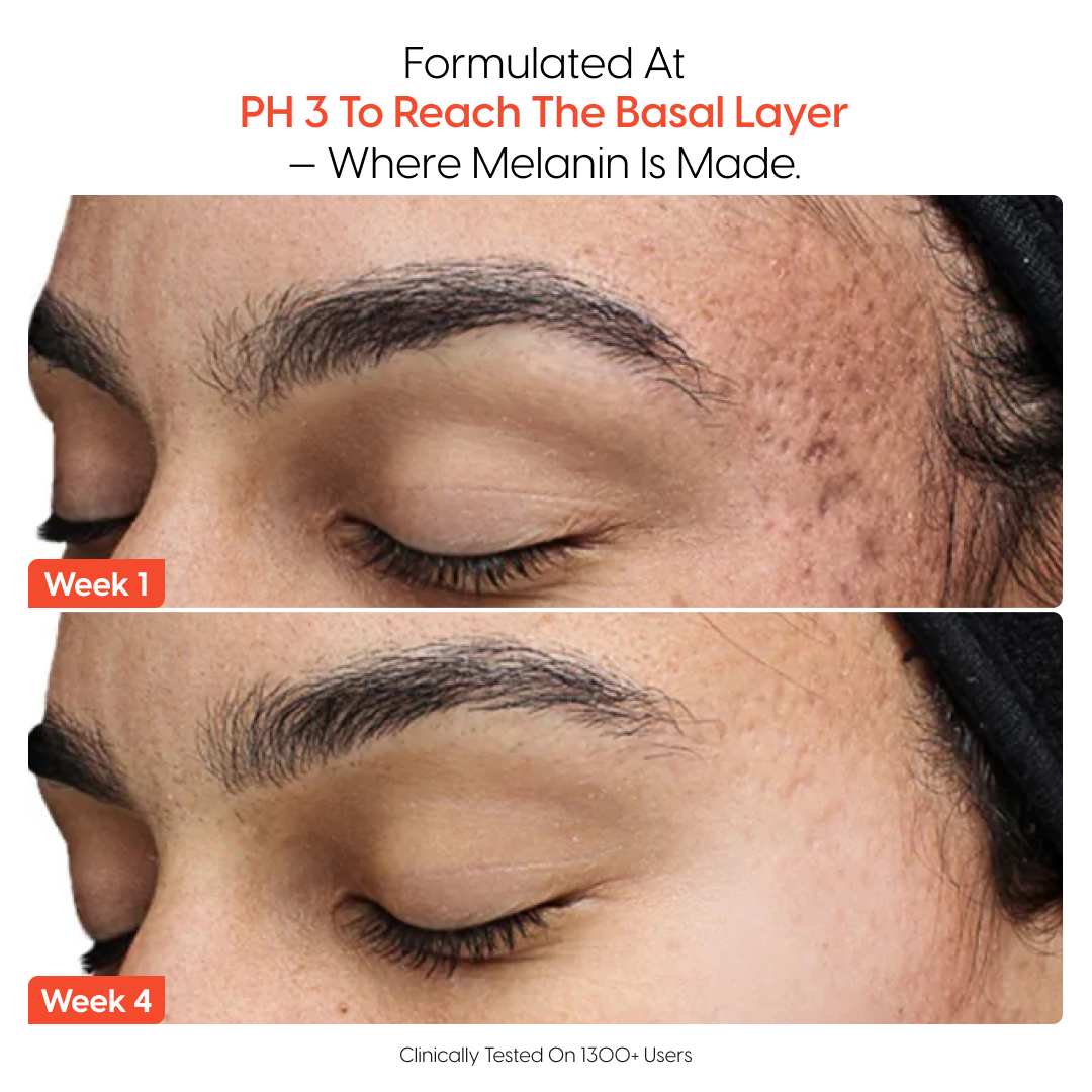 4-Week Hyperpigmentation Treatment