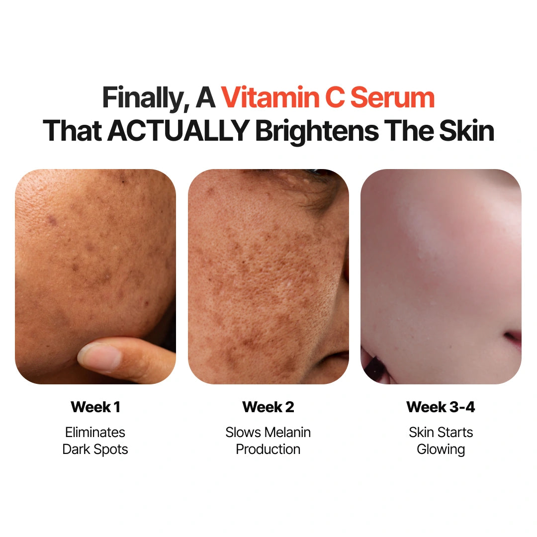 4-Week Hyperpigmentation Treatment