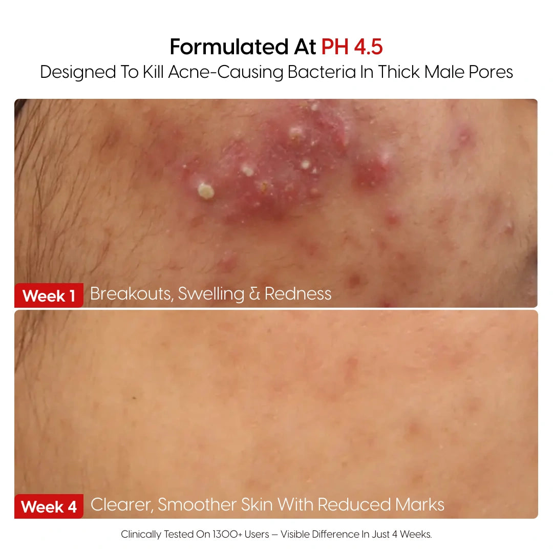 8% Pure Azelaic Acid Serum Ends Post-Shave Acne For Good