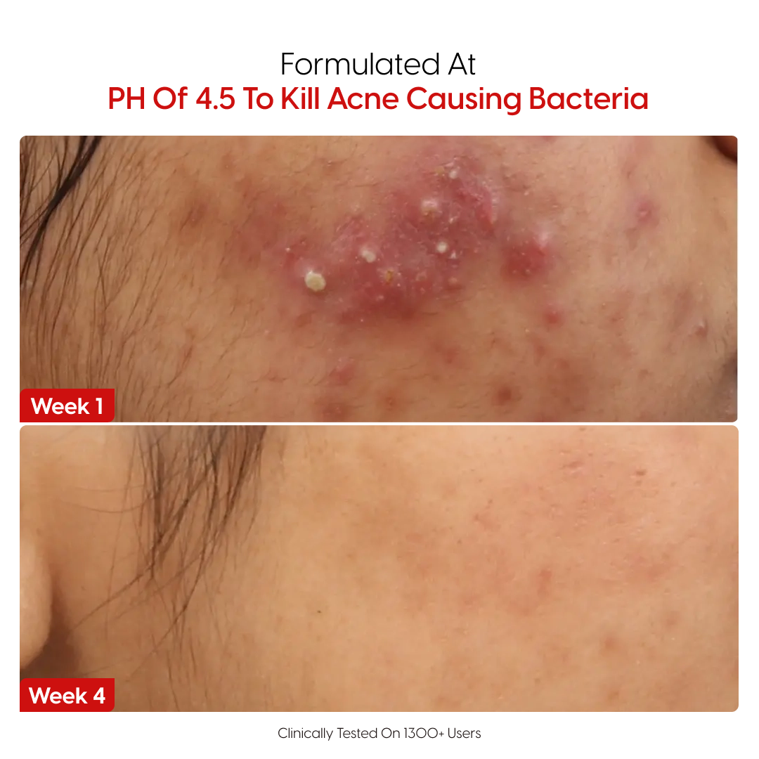 14% Pure Azelaic Acid Serum The Only Ingredient That Truly Ends Acne