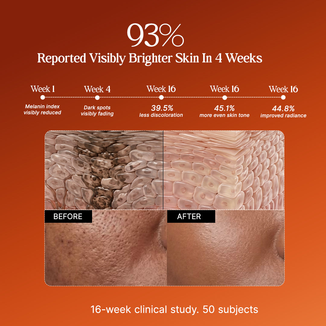 4-Week Hyperpigmentation Treatment