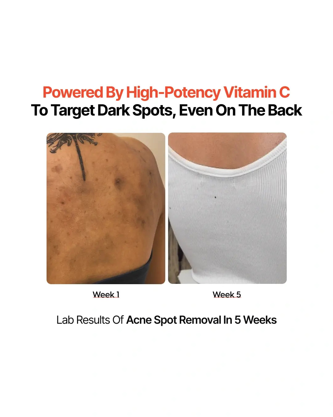 4-Week Hyperpigmentation Treatment