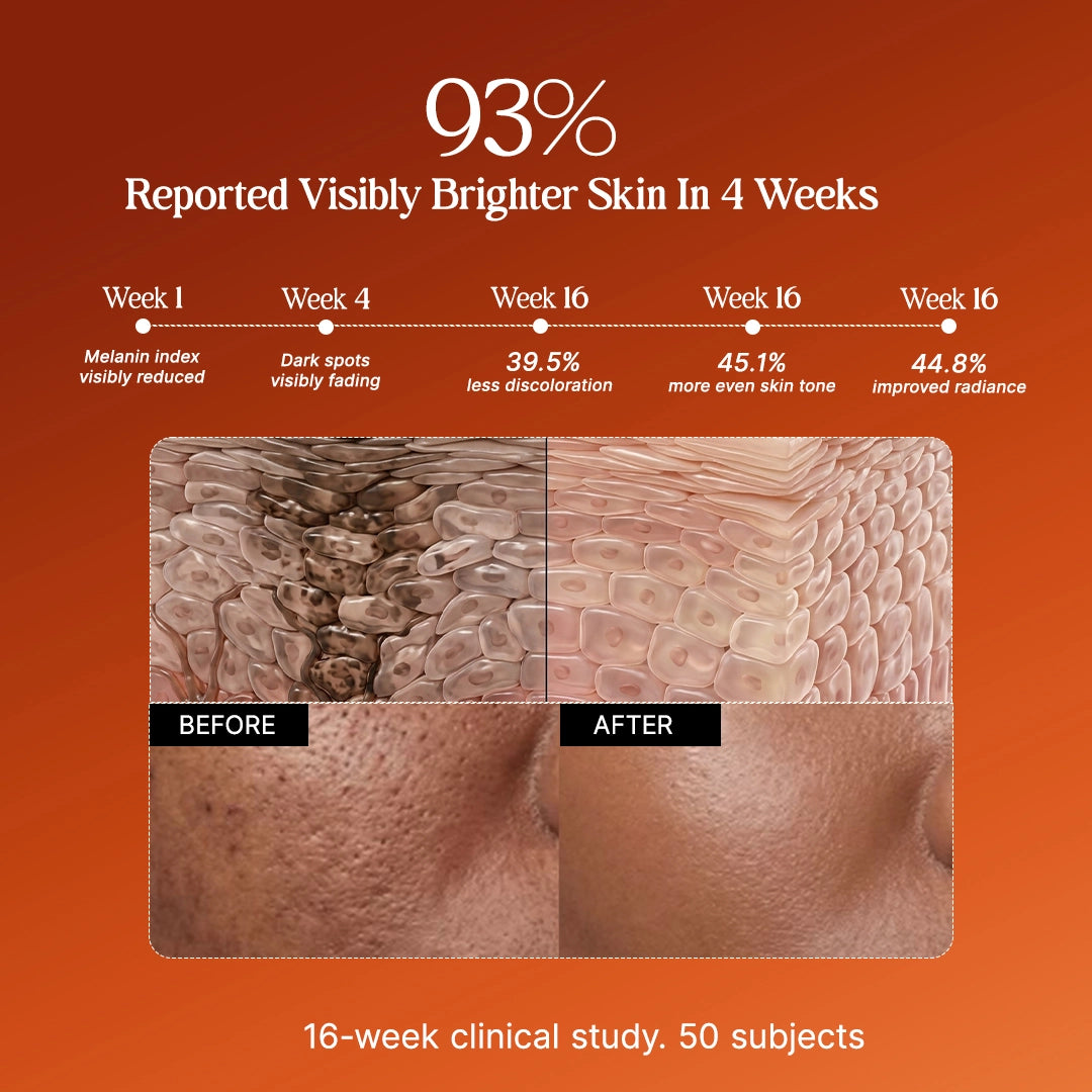 4-Week Hyperpigmentation Treatment