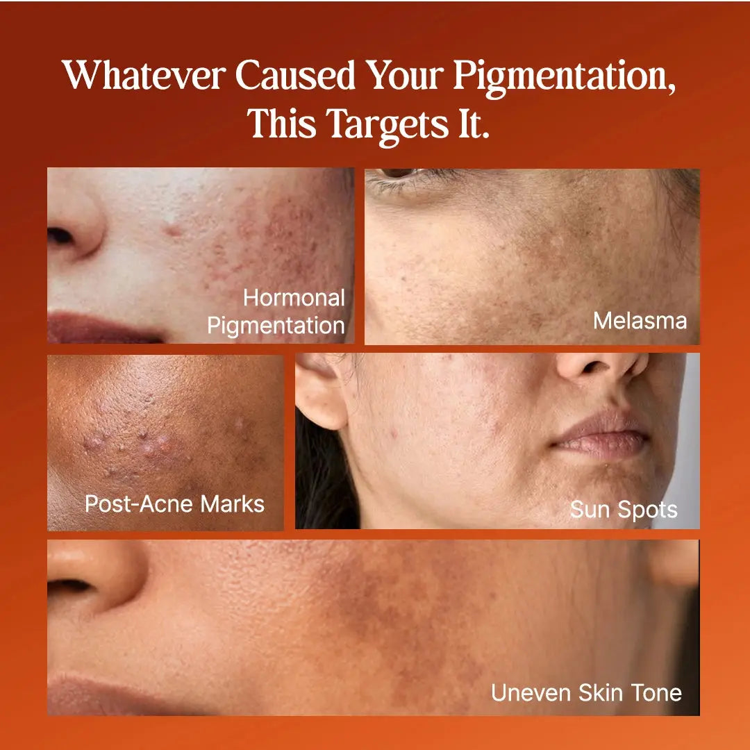 4-Week Hyperpigmentation Treatment purecosmeceuticals