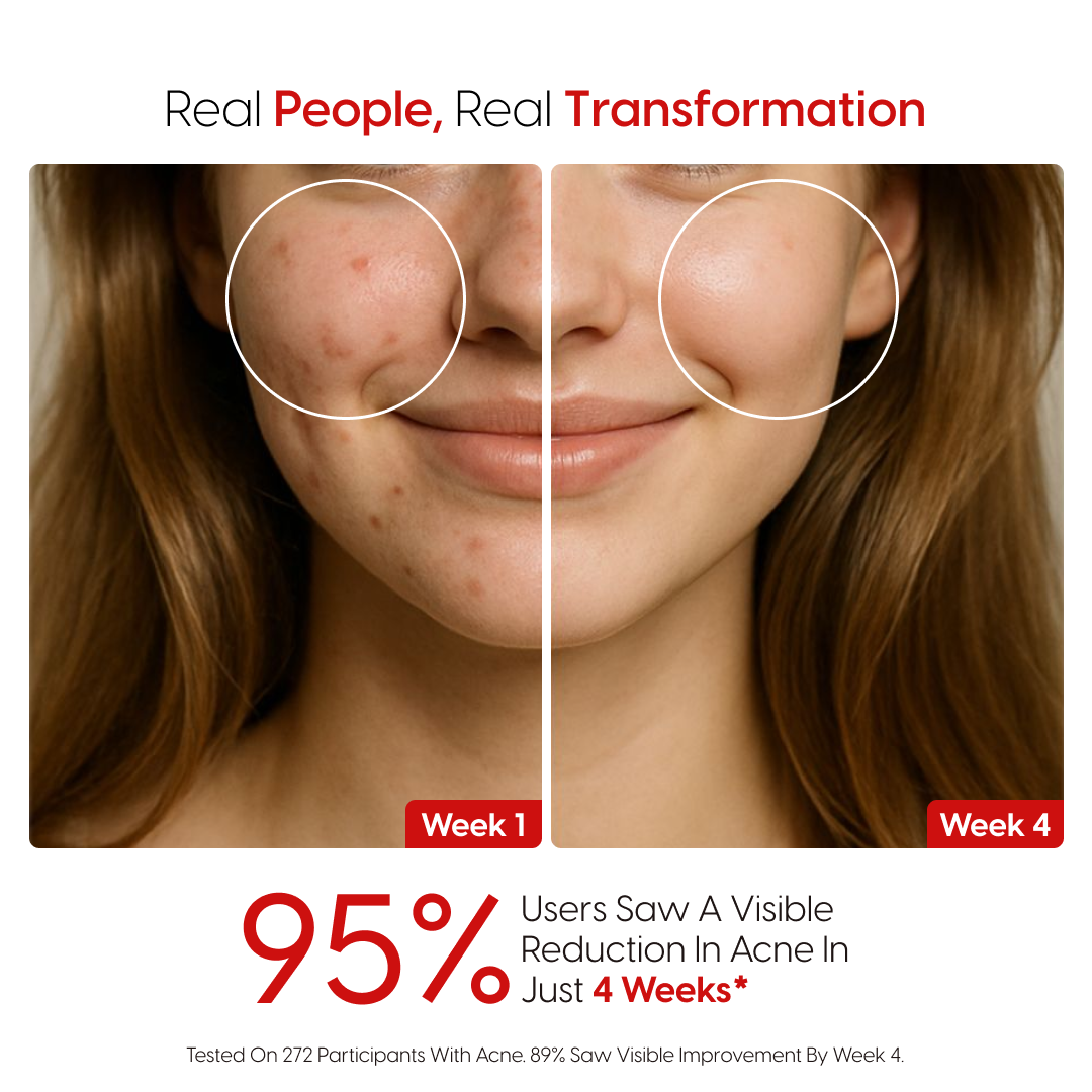 14% Pure Azelaic Acid Serum The Only Ingredient That Truly Ends Acne
