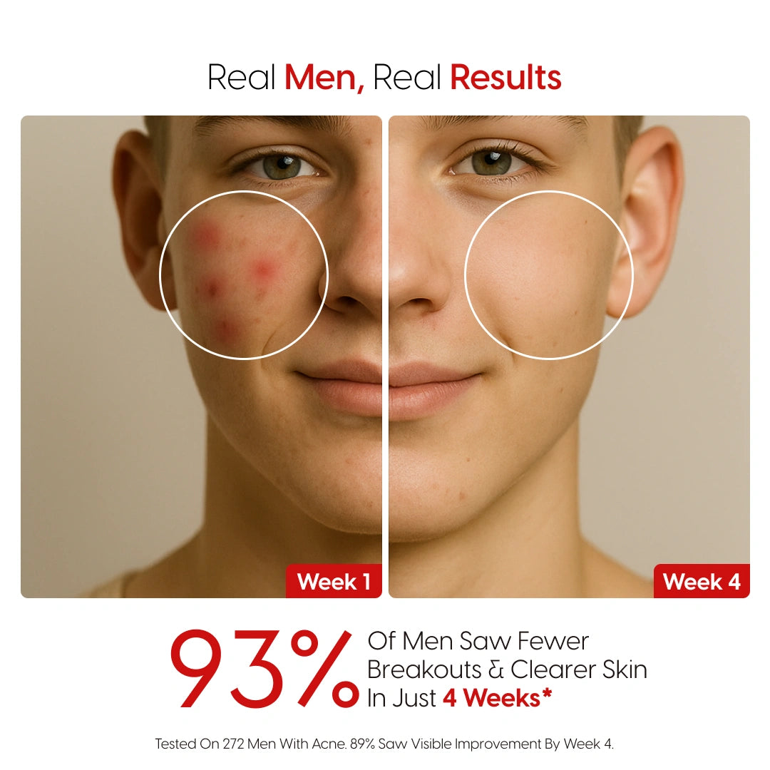 8% Pure Azelaic Acid Serum Ends Post-Shave Acne For Good