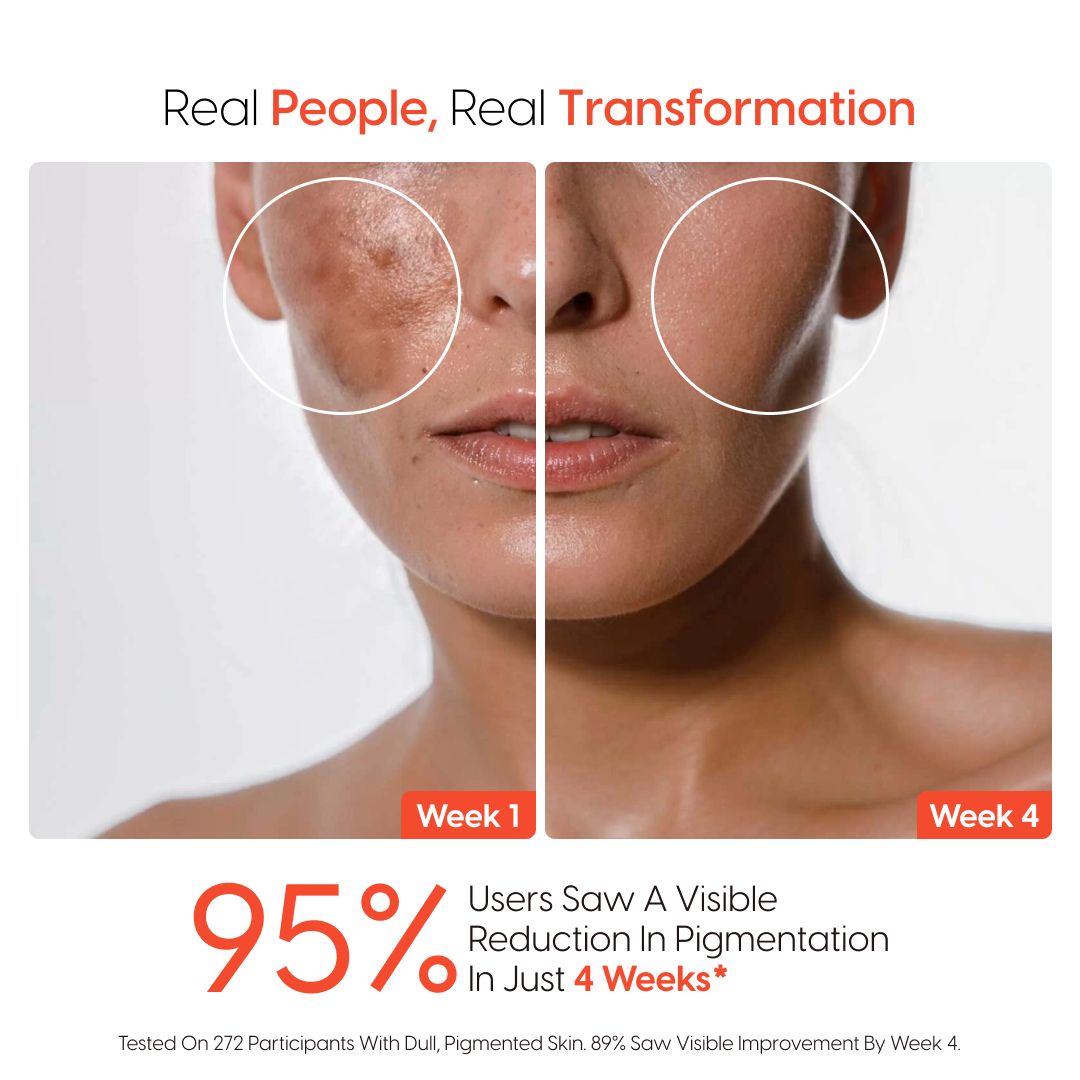 4-Week Hyperpigmentation Treatment