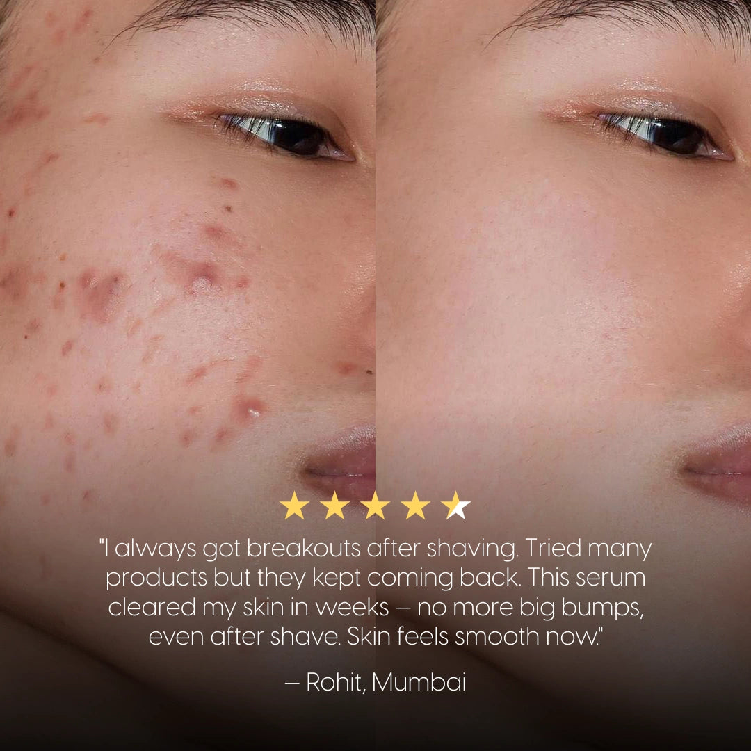 8% Pure Azelaic Acid Serum Ends Post-Shave Acne For Good