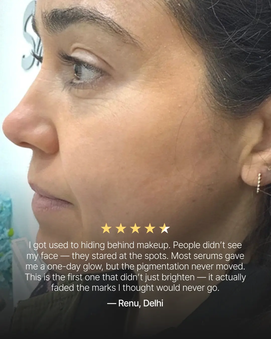 4-Week Hyperpigmentation Treatment